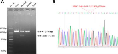 Case Report: The third-generation sequencing confirmed a novel 7.2 Kb deletion at β-globin gene in a patient with rare β-thalassemia